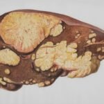 Is Dalia Good for Fatty Liver?